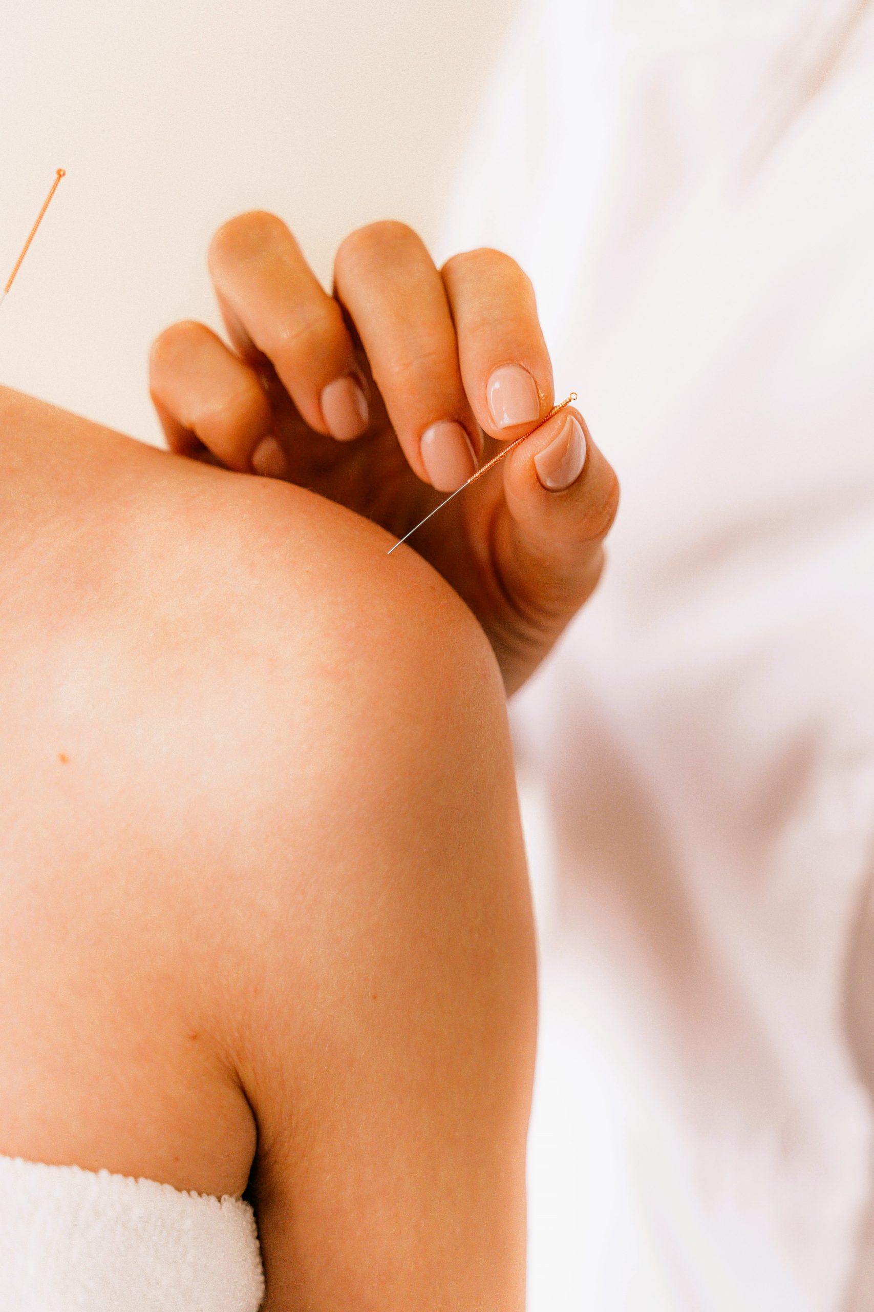 Acupuncture Therapy: A Symbol of Natural Healing, Rejuvenation, and Health Restoration.